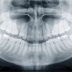 An x-ray of a human jaw, with problematic wisdom teeth